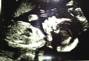 Ultrasound photo